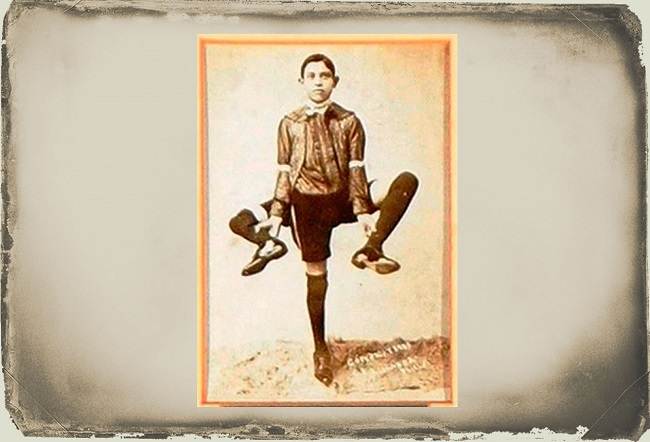 üç bacaklı adam Frank Lentini